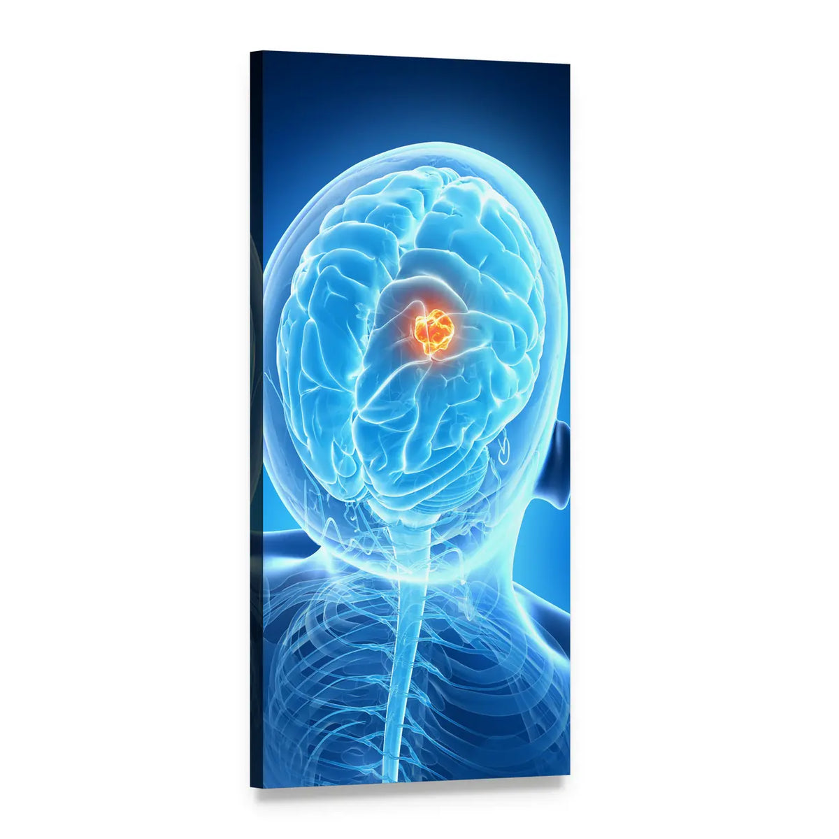 Brain Tumor Illustration with Glowing Core Vertical Canvas Wall Art, 1 panel 1 Vertical layout gallery wrapped canvas set, angled product view