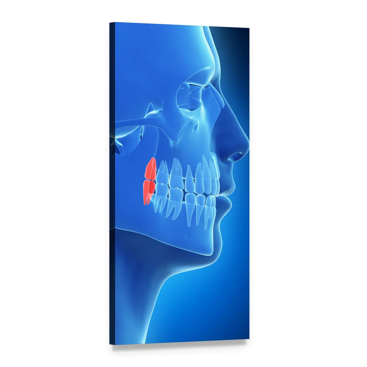 Wisdom Teeth X-ray Illustration Vertical Canvas Wall Art, 1 panel 1 Vertical layout gallery wrapped canvas set, angled product view