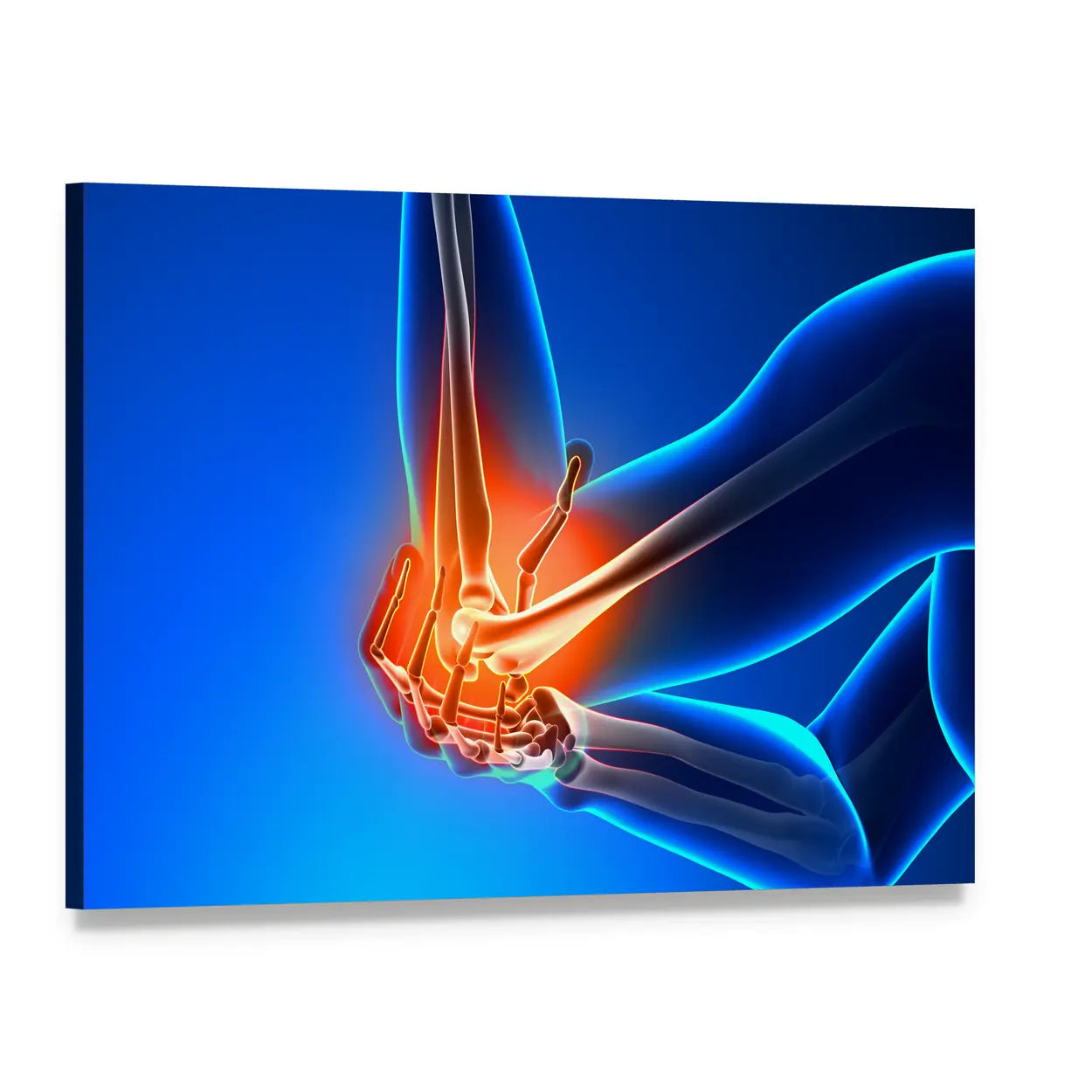 Elbow Joint Pain Illustration Canvas Wall Art, single panel gallery wrapped canvas, angled product view