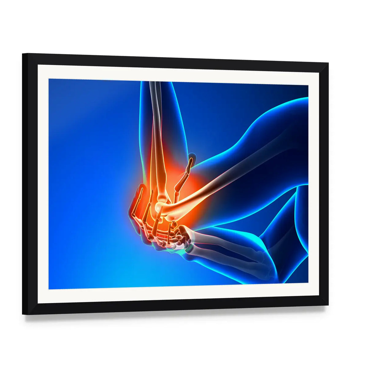 Elbow Joint Pain Illustration Canvas Wall Art, framed print with white mat and black frame, angled product view