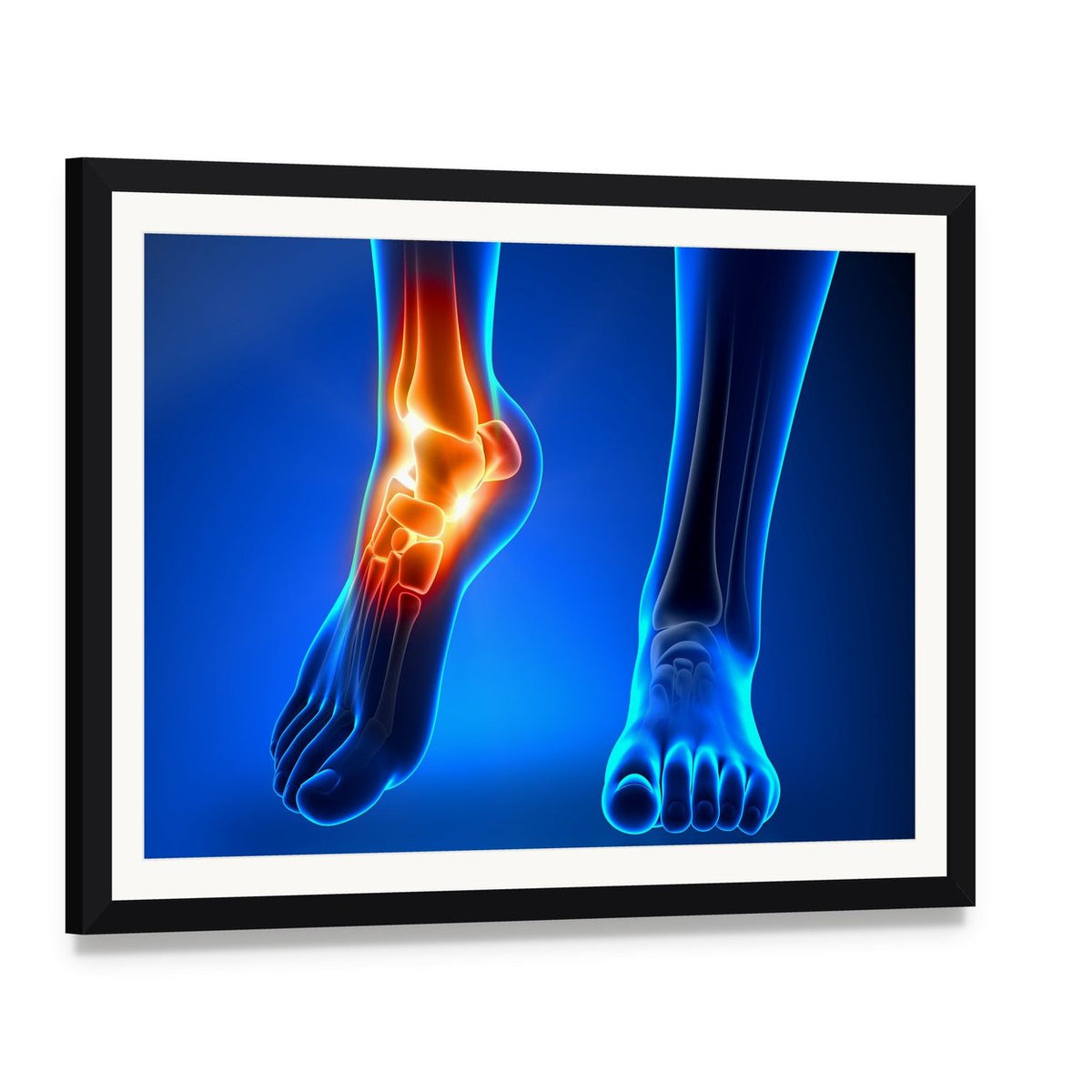 Inflamed Left Ankle Illustration Canvas Wall Art, framed print with white mat and black frame, angled product view