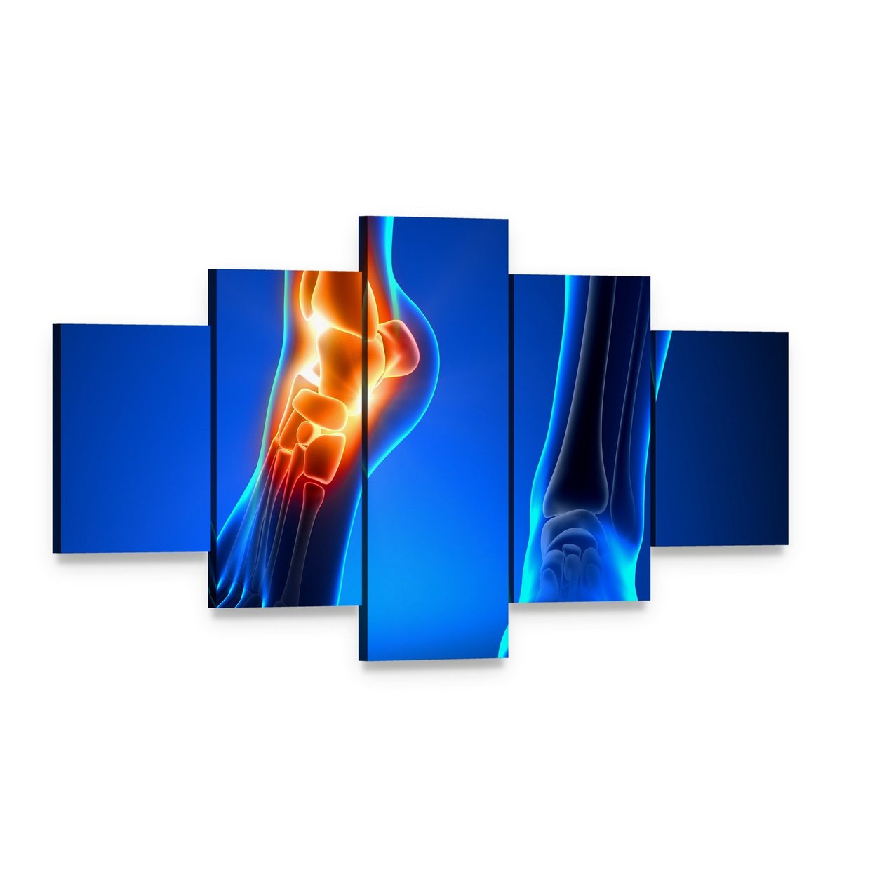 Inflamed Left Ankle Illustration Canvas Wall Art, 5 panel 5 Star layout gallery wrapped canvas set, angled product view
