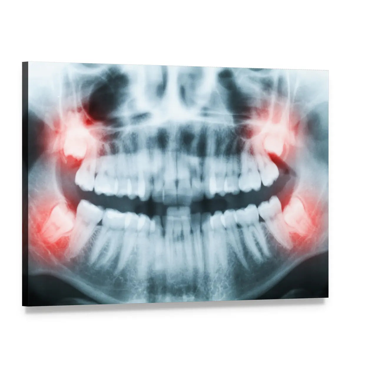 Dental X-ray with Glowing Wisdom Teeth Canvas Wall Art, single panel gallery wrapped canvas, angled product view