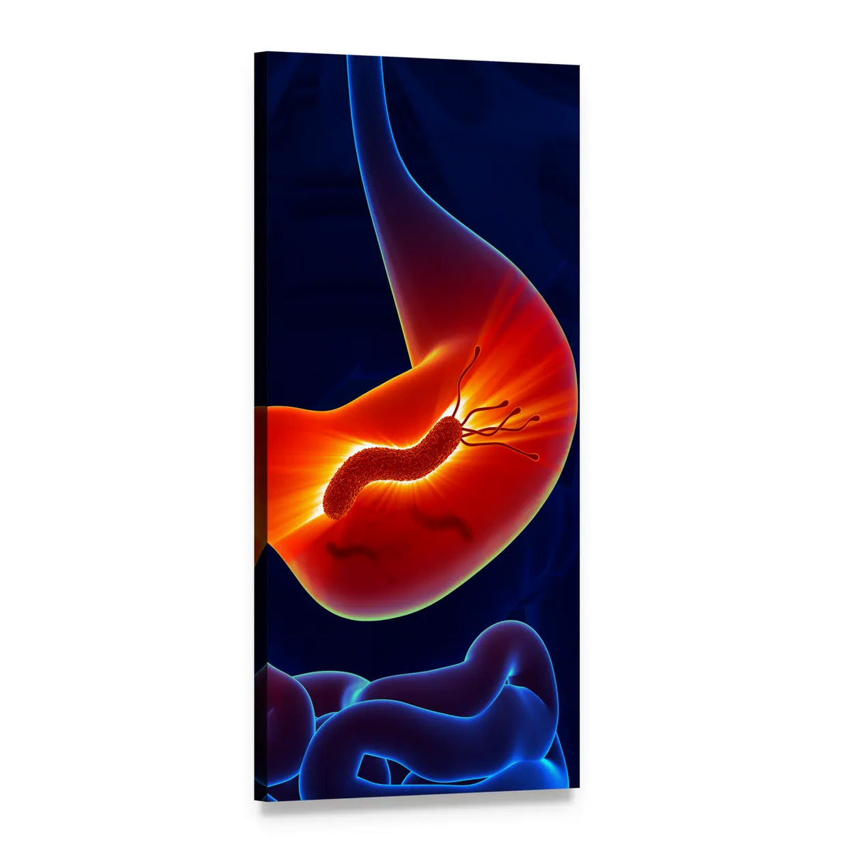 Inflamed Stomach with H. Pylori Illustration Vertical Canvas Wall Art, 1 panel 1 Vertical layout gallery wrapped canvas set, angled product view