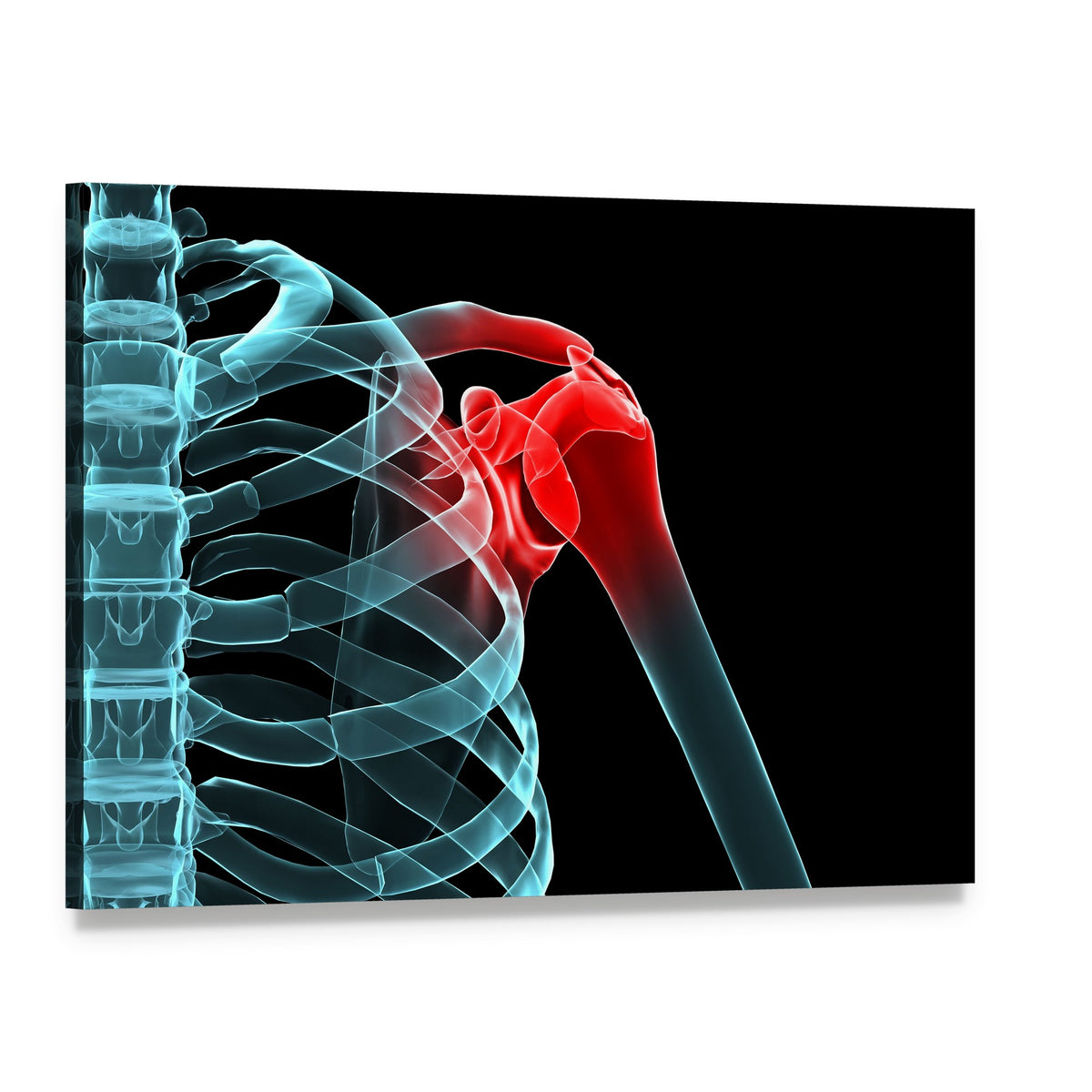 X-ray of Painful Shoulder Canvas Wall Art, single panel gallery wrapped canvas, angled product view