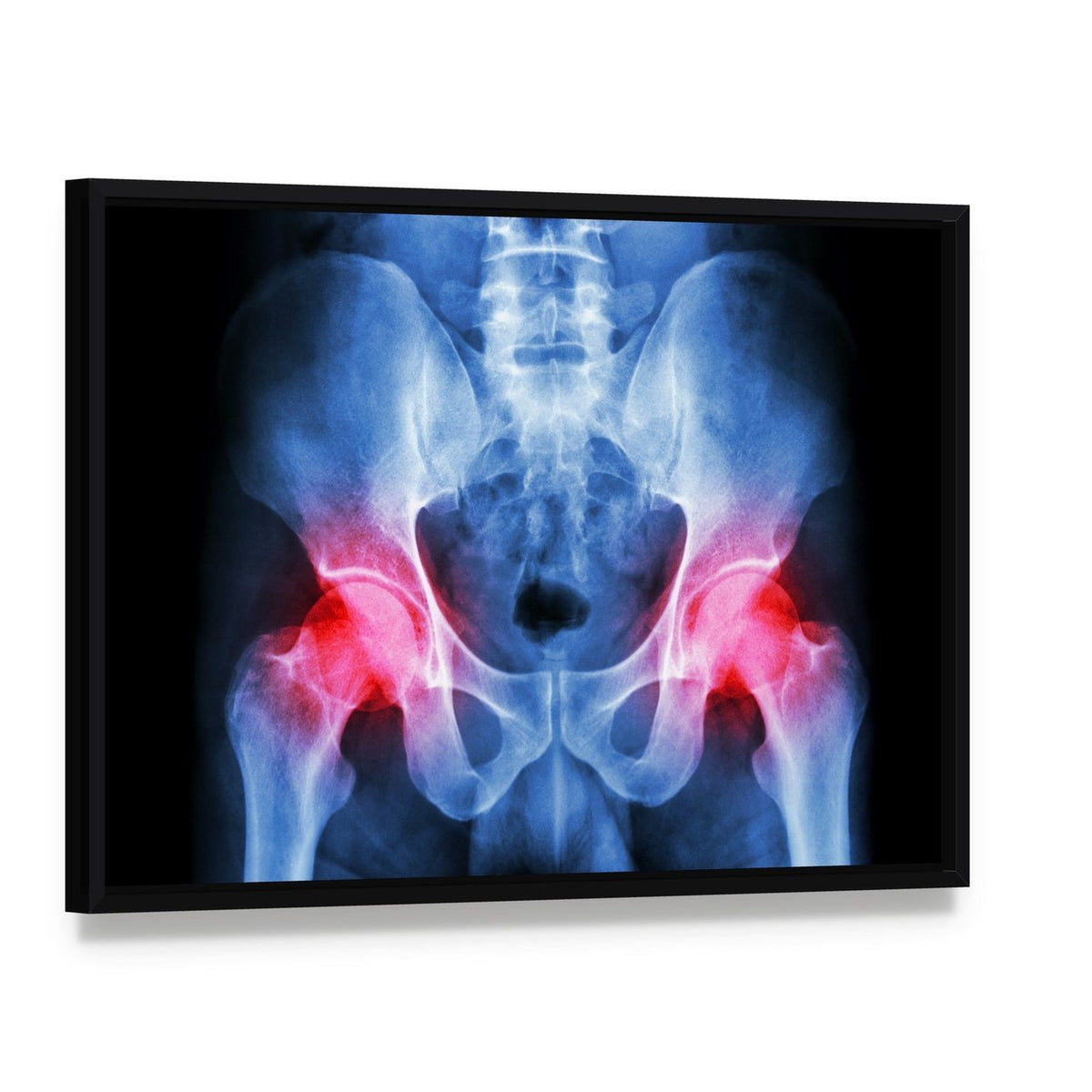 Pelvis X-ray Canvas Wall Art, framed canvas in a black floater frame, angled product view