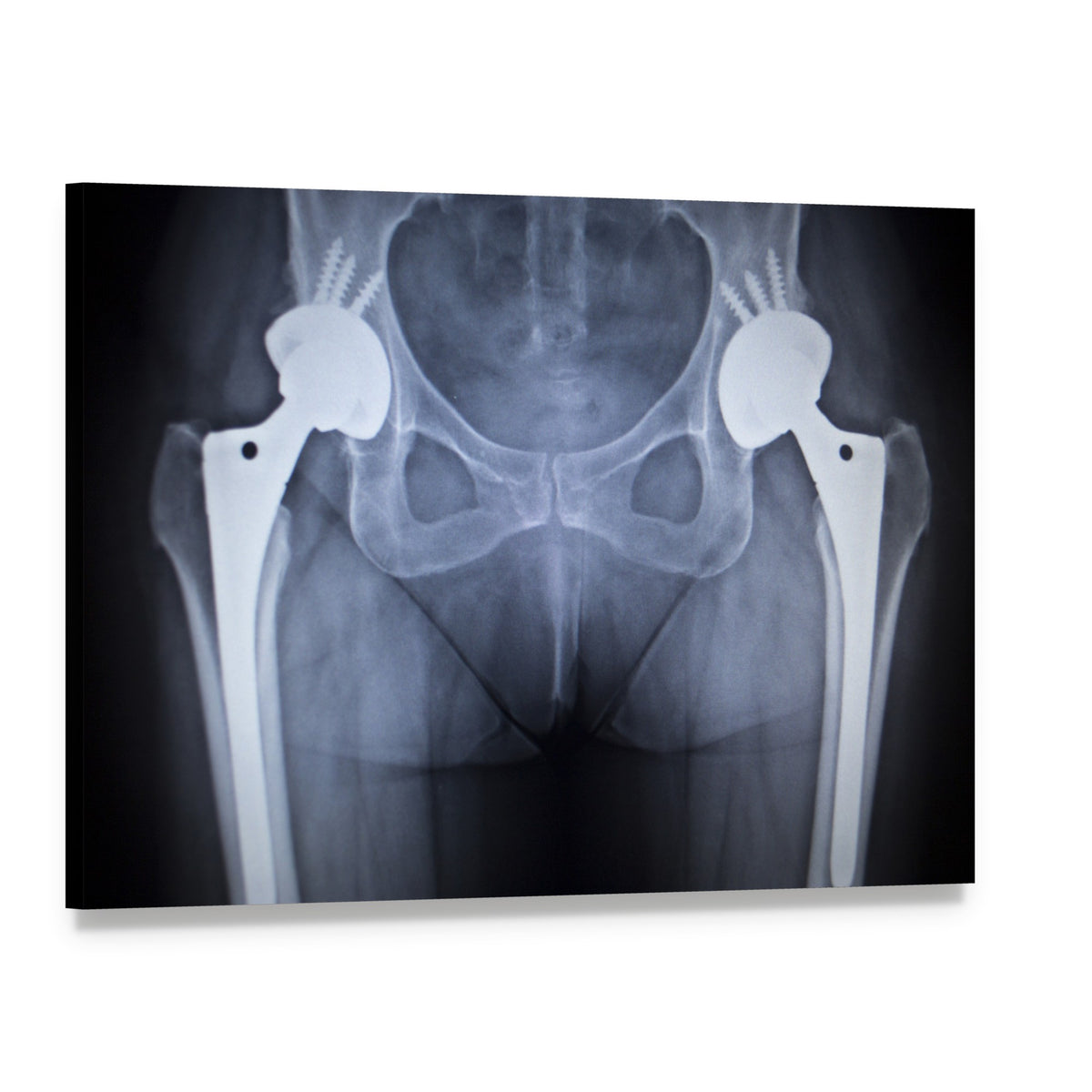 Bilateral Hip Prostheses X-ray Canvas Wall Art, single panel gallery wrapped canvas, angled product view