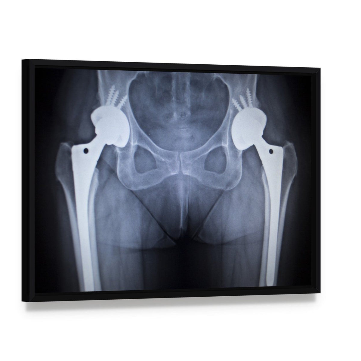Bilateral Hip Prostheses X-ray Canvas Wall Art, framed canvas in a black floater frame, angled product view
