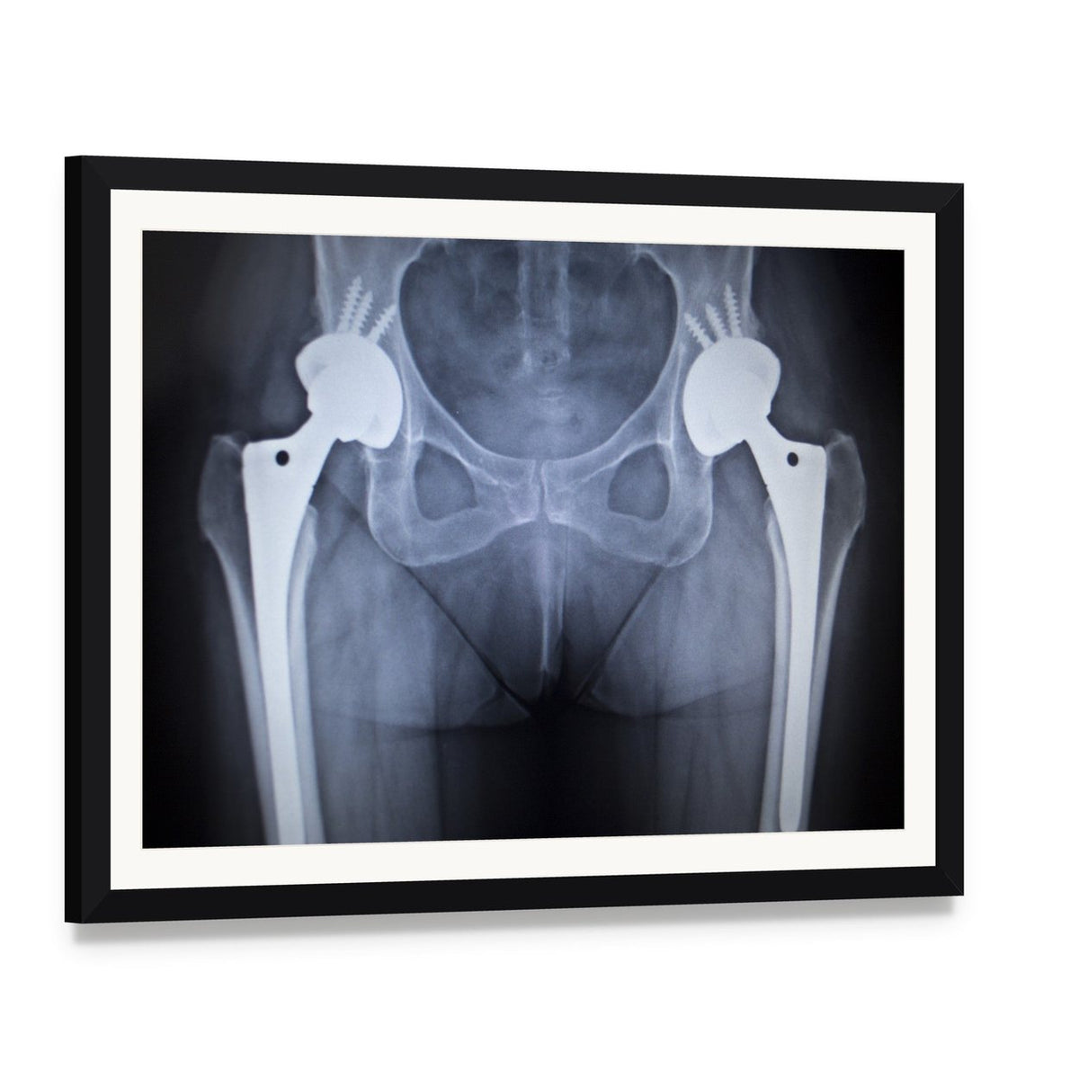 Bilateral Hip Prostheses X-ray Canvas Wall Art, framed print with white mat and black frame, angled product view