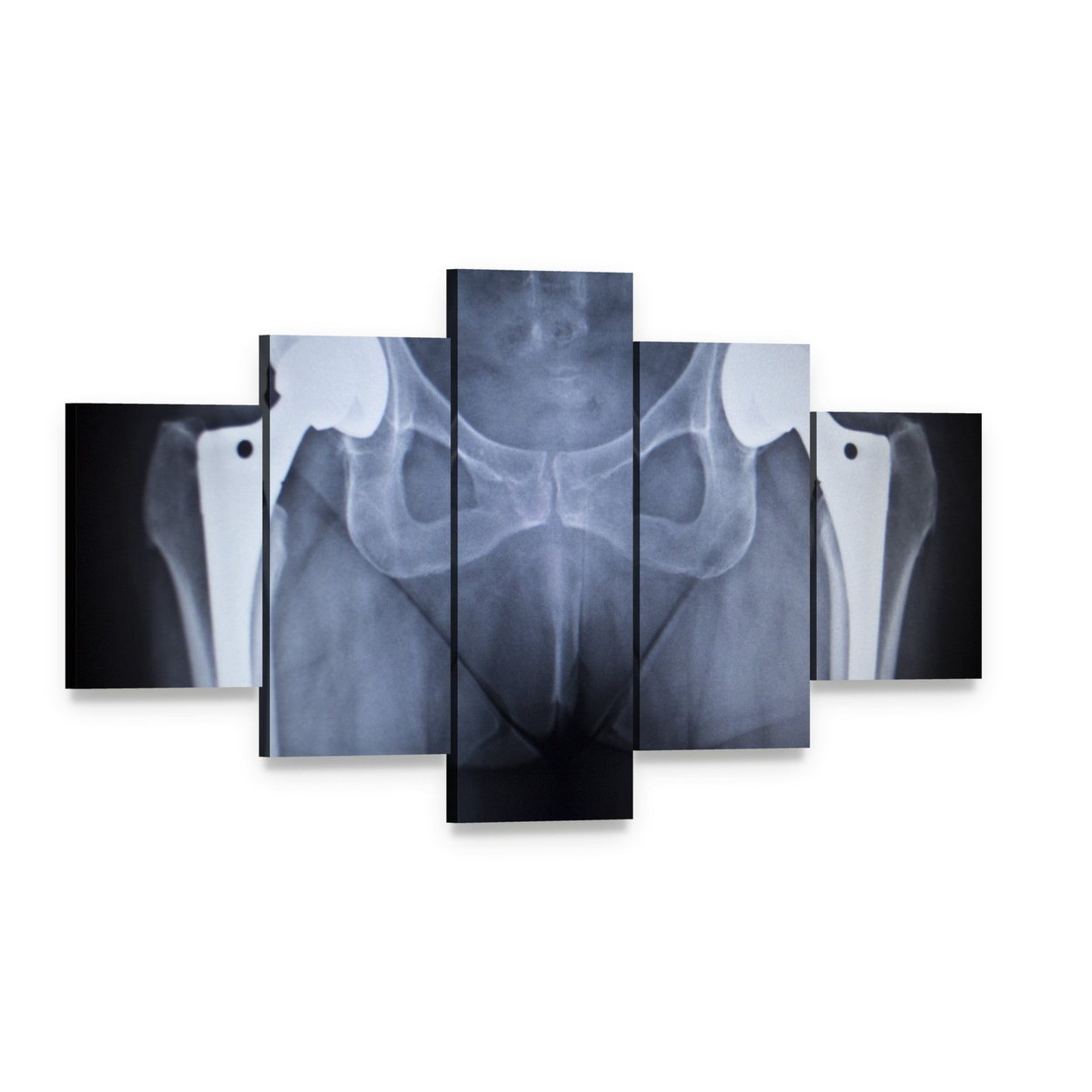 Bilateral Hip Prostheses X-ray Canvas Wall Art, 5 panel 5 Star layout gallery wrapped canvas set, angled product view