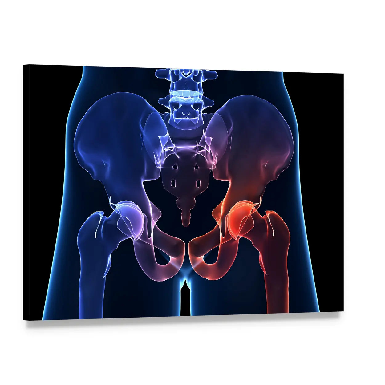 Human Hip Pain Anatomy Canvas Wall Art, single panel gallery wrapped canvas, angled product view