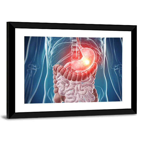 Painful Stomach Anatomical Illustration Canvas Wall Art