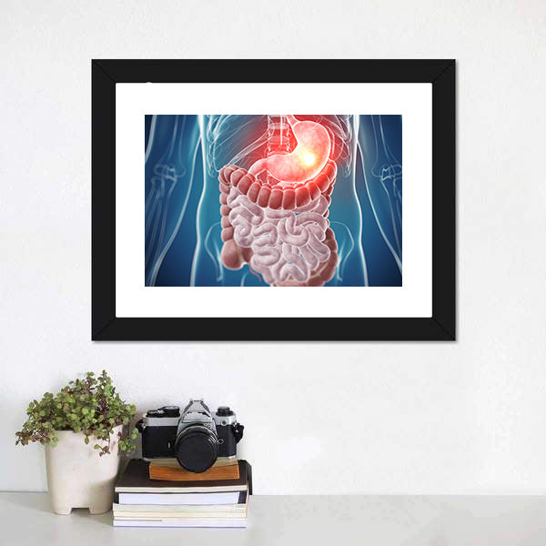 Painful Stomach Anatomical Illustration Canvas Wall Art