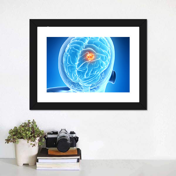 Glowing Brain Tumor Illustration Canvas Wall Art