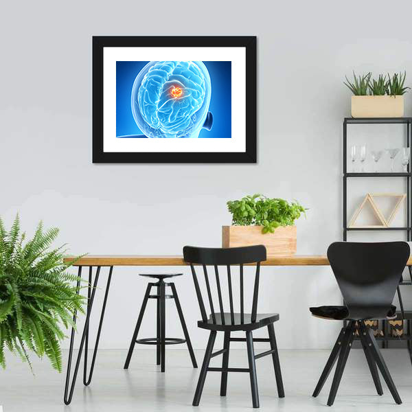 Glowing Brain Tumor Illustration Canvas Wall Art