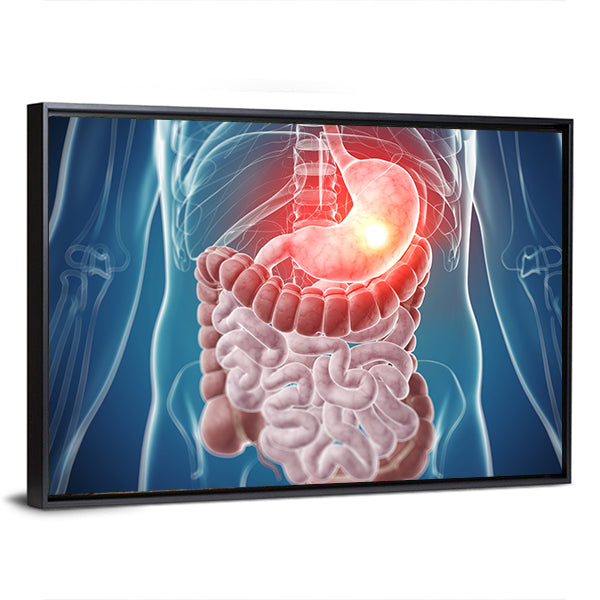 Painful Stomach Anatomical Illustration Canvas Wall Art