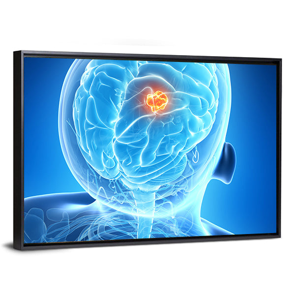 Glowing Brain Tumor Illustration Canvas Wall Art