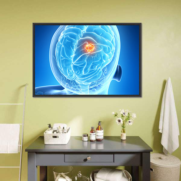 Glowing Brain Tumor Illustration Canvas Wall Art