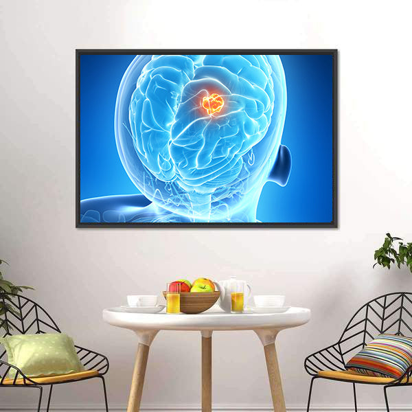 Glowing Brain Tumor Illustration Canvas Wall Art