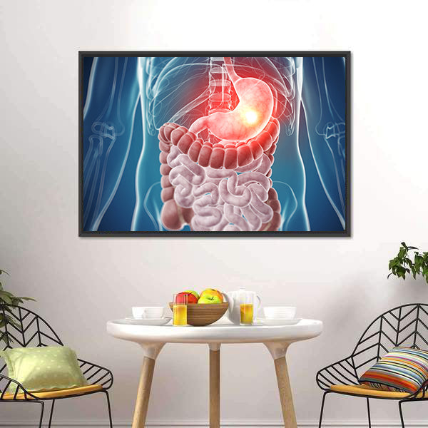 Painful Stomach Anatomical Illustration Canvas Wall Art