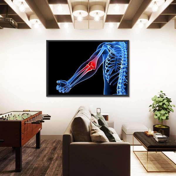 Painful Elbow Illustration Canvas Wall Art-5 Horizontal-Gallery Wrap-22" x 12"-Tiaracle