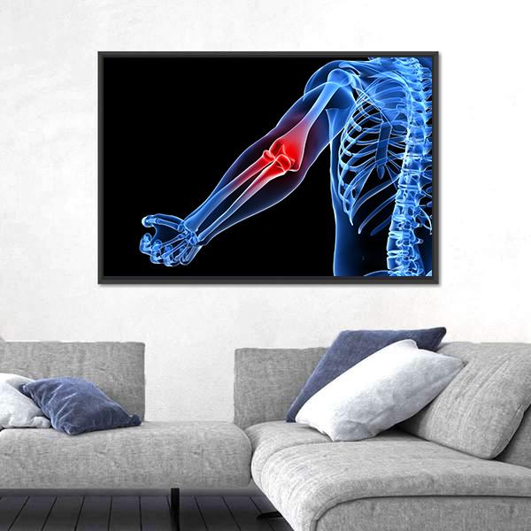 Painful Elbow Illustration Canvas Wall Art-5 Horizontal-Gallery Wrap-22" x 12"-Tiaracle