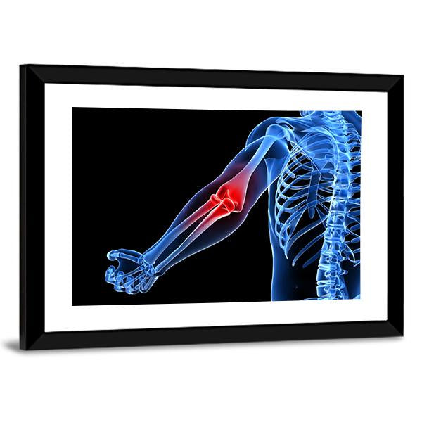 Painful Elbow Illustration Canvas Wall Art-5 Horizontal-Gallery Wrap-22" x 12"-Tiaracle