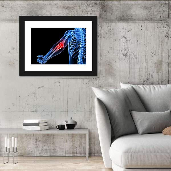 Painful Elbow Illustration Canvas Wall Art-5 Horizontal-Gallery Wrap-22" x 12"-Tiaracle