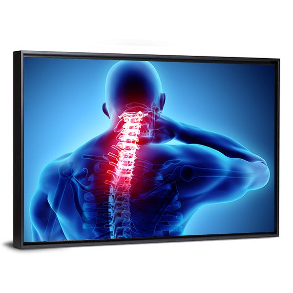 Painful Neck With Cervical Spine Skeleton X-Ray Canvas Wall Art-3 Horizontal-Gallery Wrap-25" x 16"-Tiaracle