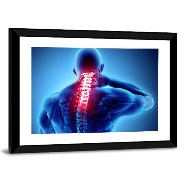 Painful Neck With Cervical Spine Skeleton X-Ray Canvas Wall Art-3 Horizontal-Gallery Wrap-25" x 16"-Tiaracle