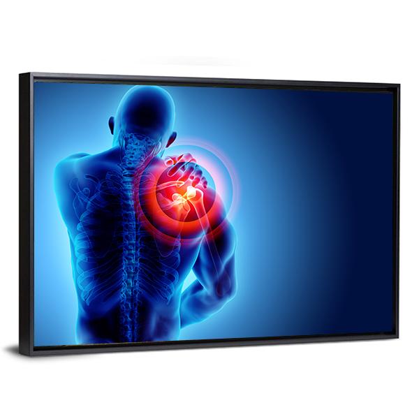 Shoulder Painful Skeleton X-Ray Canvas Wall Art-3 Horizontal-Gallery Wrap-25" x 16"-Tiaracle