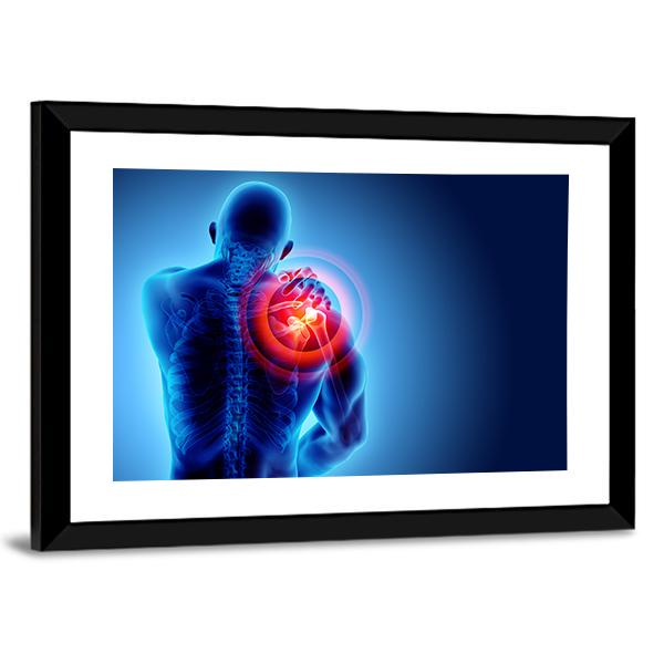 Shoulder Painful Skeleton X-Ray Canvas Wall Art-3 Horizontal-Gallery Wrap-25" x 16"-Tiaracle