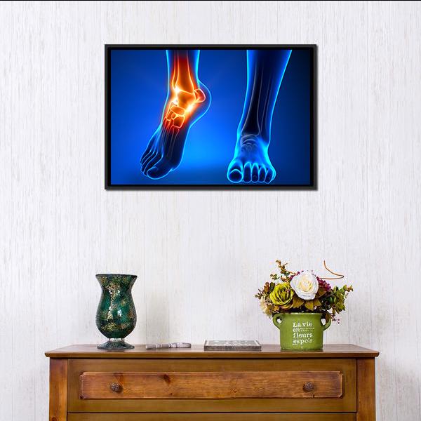 Inflamed Left Ankle Illustration Canvas Wall Art in red, orange and blue, framed canvas, product view on a white background