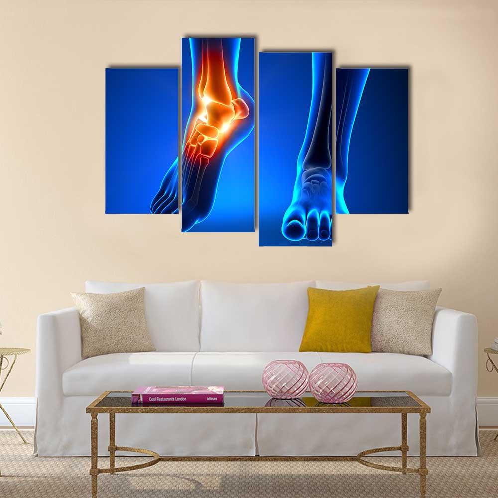 Ankle Pain Detail Canvas Wall Art-4 Pop-Gallery Wrap-50" x 32"-Tiaracle