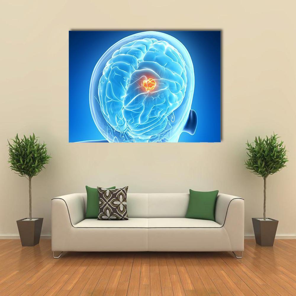 Brain Tumor Illustration Canvas Wall Art-1 Piece-Gallery Wrap-48" x 32"-Tiaracle