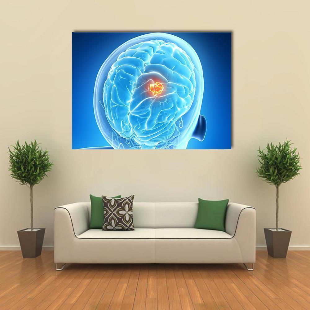 Brain Tumor Illustration Canvas Wall Art-5 Horizontal-Gallery Wrap-22" x 12"-Tiaracle