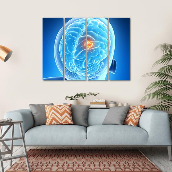 Brain Tumor Illustration Canvas Wall Art-4 Horizontal-Gallery Wrap-34" x 24"-Tiaracle