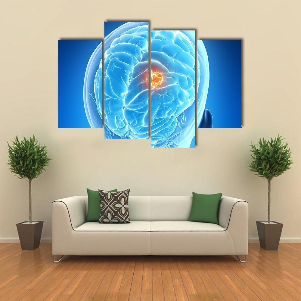 Brain Tumor Illustration Canvas Wall Art-4 Pop-Gallery Wrap-50" x 32"-Tiaracle