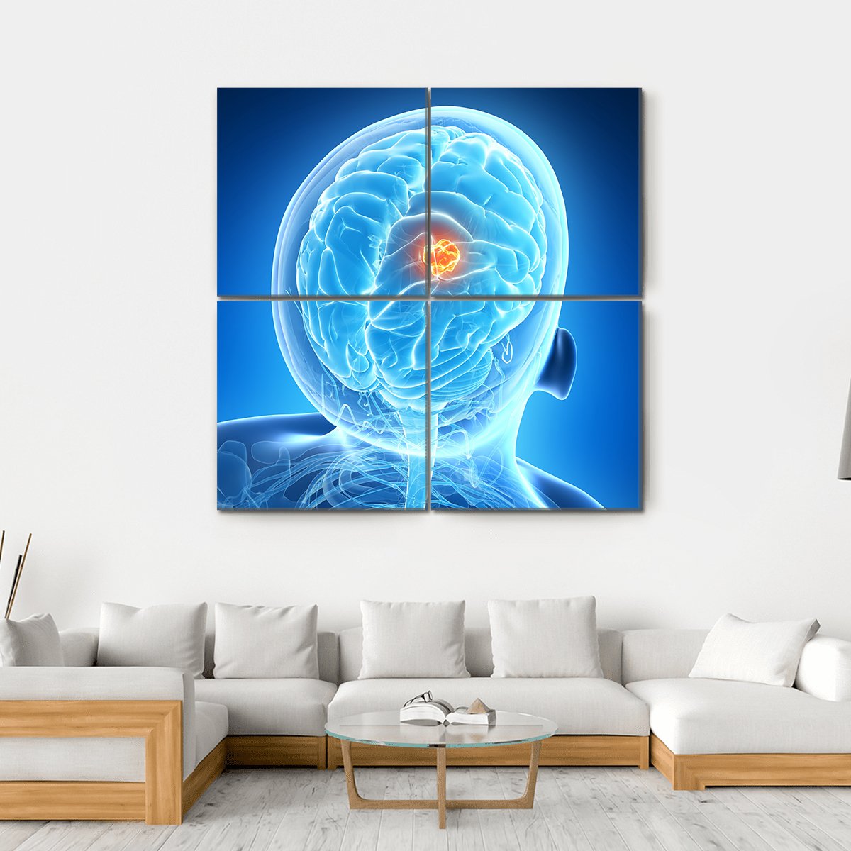 Brain Tumor Illustration Canvas Wall Art-4 Square-Gallery Wrap-17" x 17"-Tiaracle