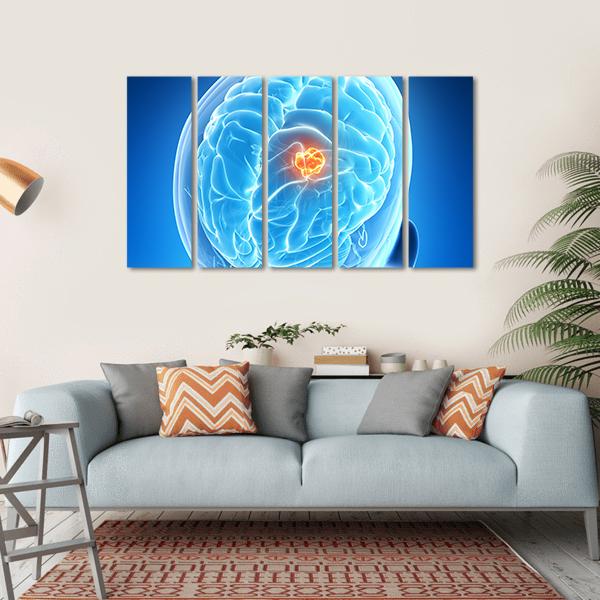 Brain Tumor Illustration Canvas Wall Art-5 Horizontal-Gallery Wrap-22" x 12"-Tiaracle