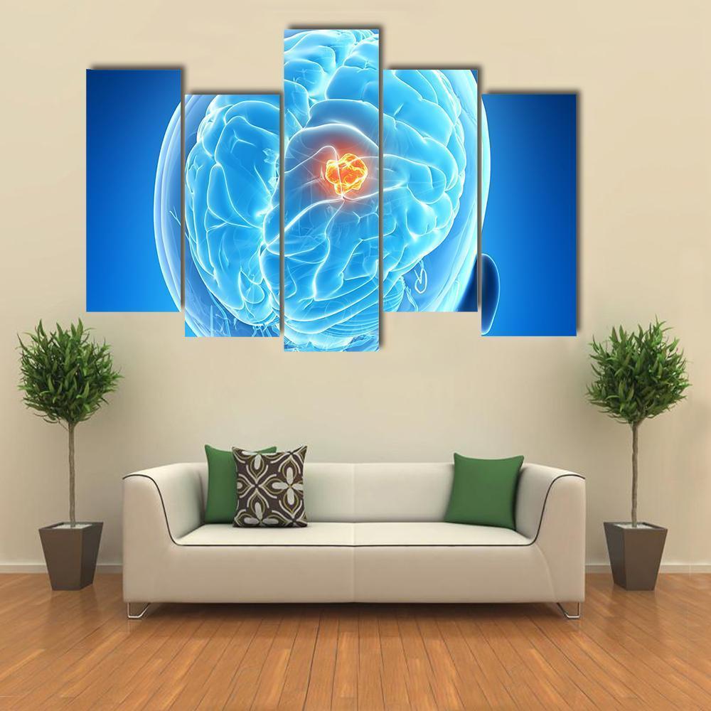 Brain Tumor Illustration Canvas Wall Art-5 Pop-Gallery Wrap-47" x 32"-Tiaracle