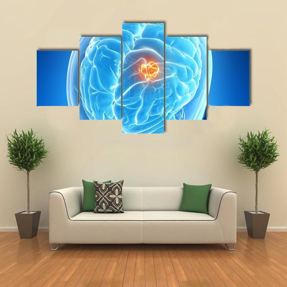 Brain Tumor Illustration Canvas Wall Art-1 Piece-Gallery Wrap-48" x 32"-Tiaracle