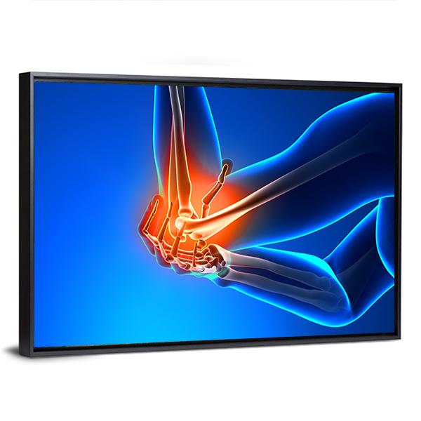 Elbow Pain Illustration Canvas Wall Art-5 Horizontal-Gallery Wrap-22" x 12"-Tiaracle