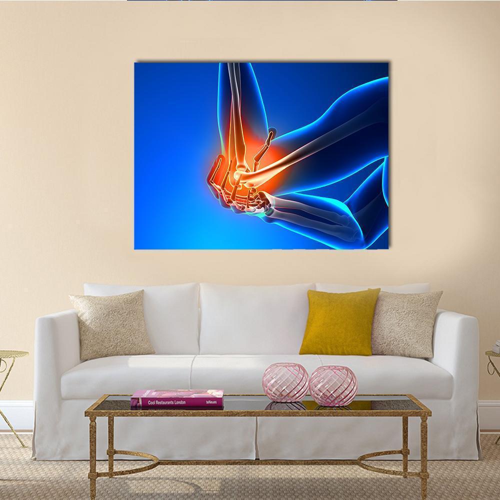 Elbow Joint Pain Illustration Canvas Wall Art in red, orange and blue, single panel hung on a wall