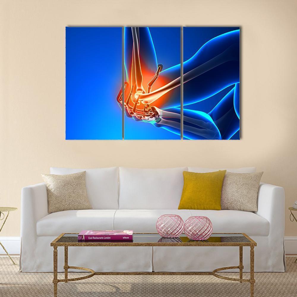 Elbow Pain Illustration Canvas Wall Art-3 Horizontal-Gallery Wrap-37" x 24"-Tiaracle