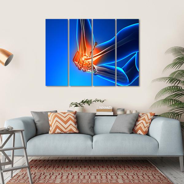 Elbow Pain Illustration Canvas Wall Art-4 Horizontal-Gallery Wrap-34" x 24"-Tiaracle