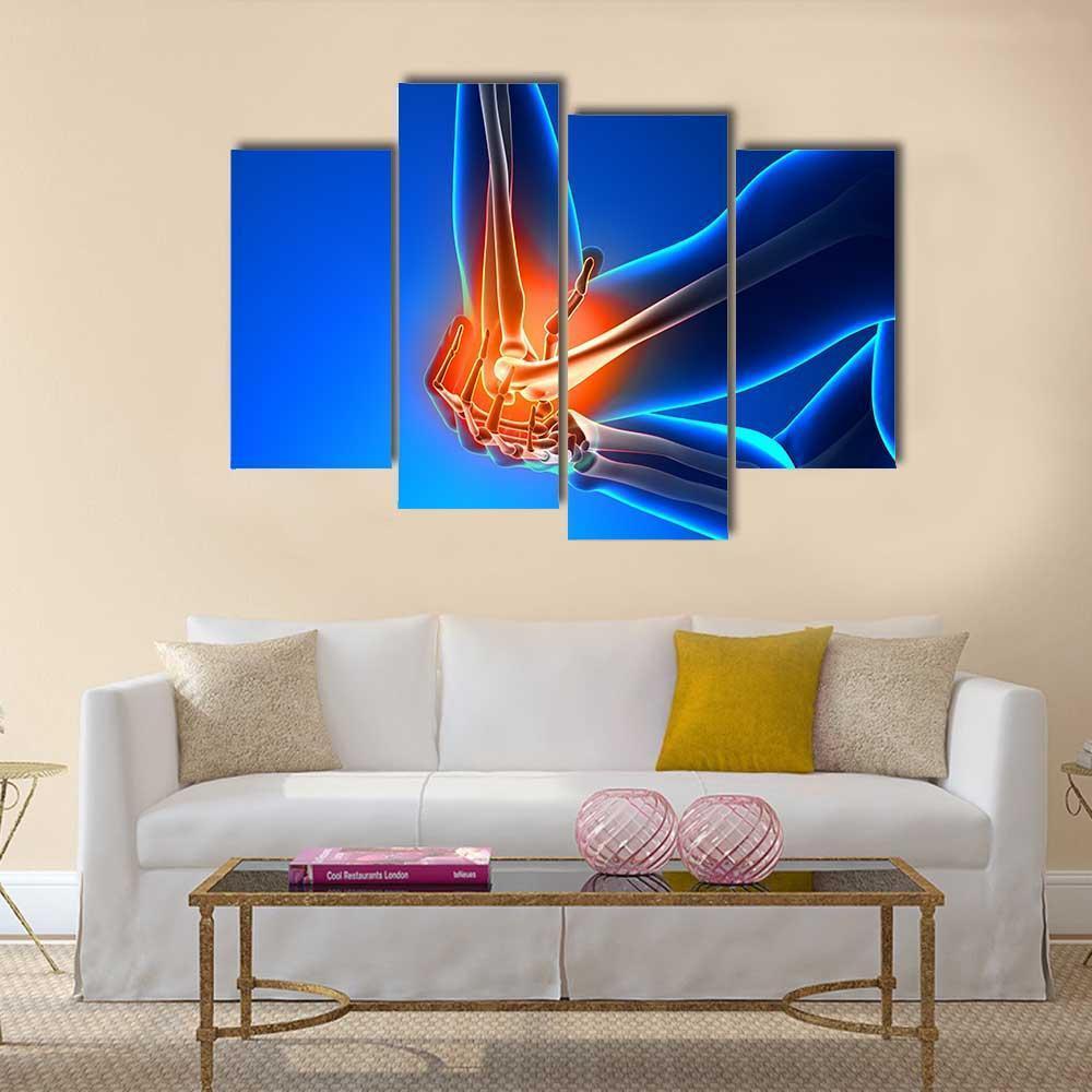 Elbow Pain Illustration Canvas Wall Art-4 Pop-Gallery Wrap-50" x 32"-Tiaracle