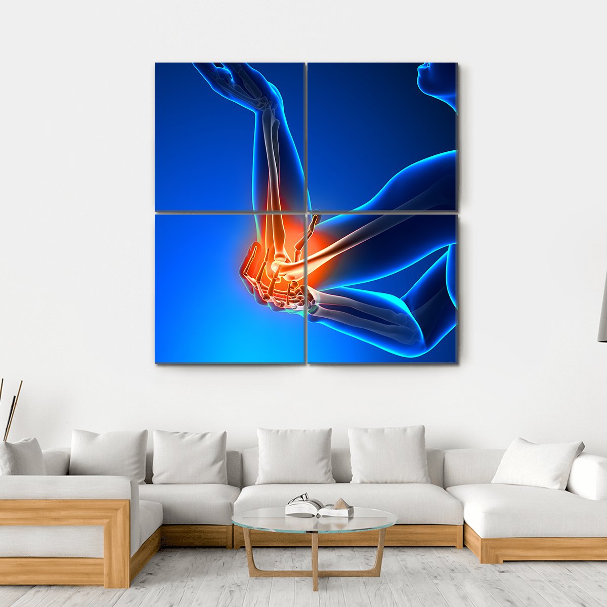 Elbow Pain Illustration Canvas Wall Art-4 Square-Gallery Wrap-17" x 17"-Tiaracle