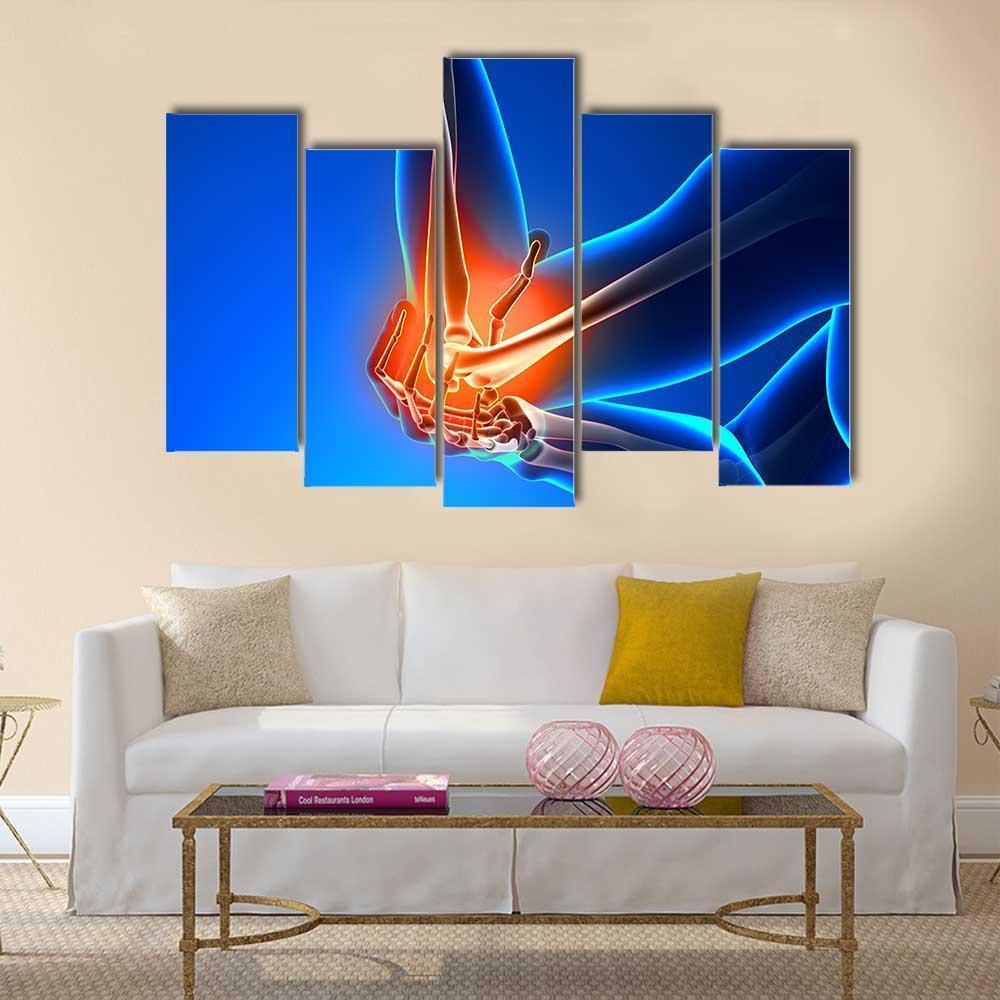 Elbow Pain Illustration Canvas Wall Art-5 Pop-Gallery Wrap-47" x 32"-Tiaracle