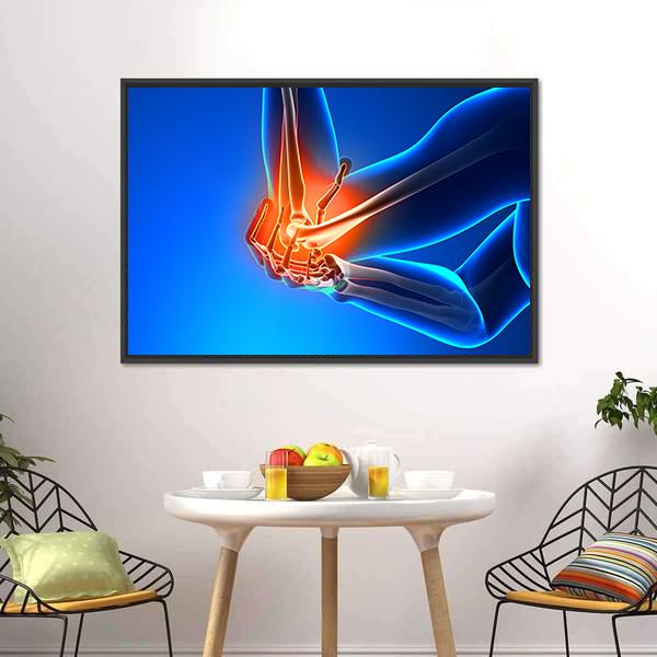 Elbow Joint Pain Illustration Canvas Wall Art in red, orange and blue, framed canvas, product view on a white background